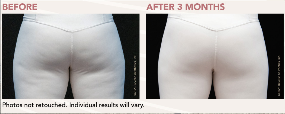 Aveli Before and After Image